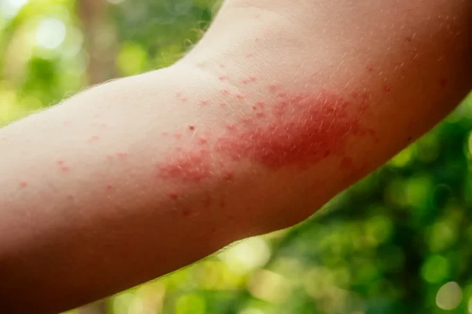 poison ivy rash on hand