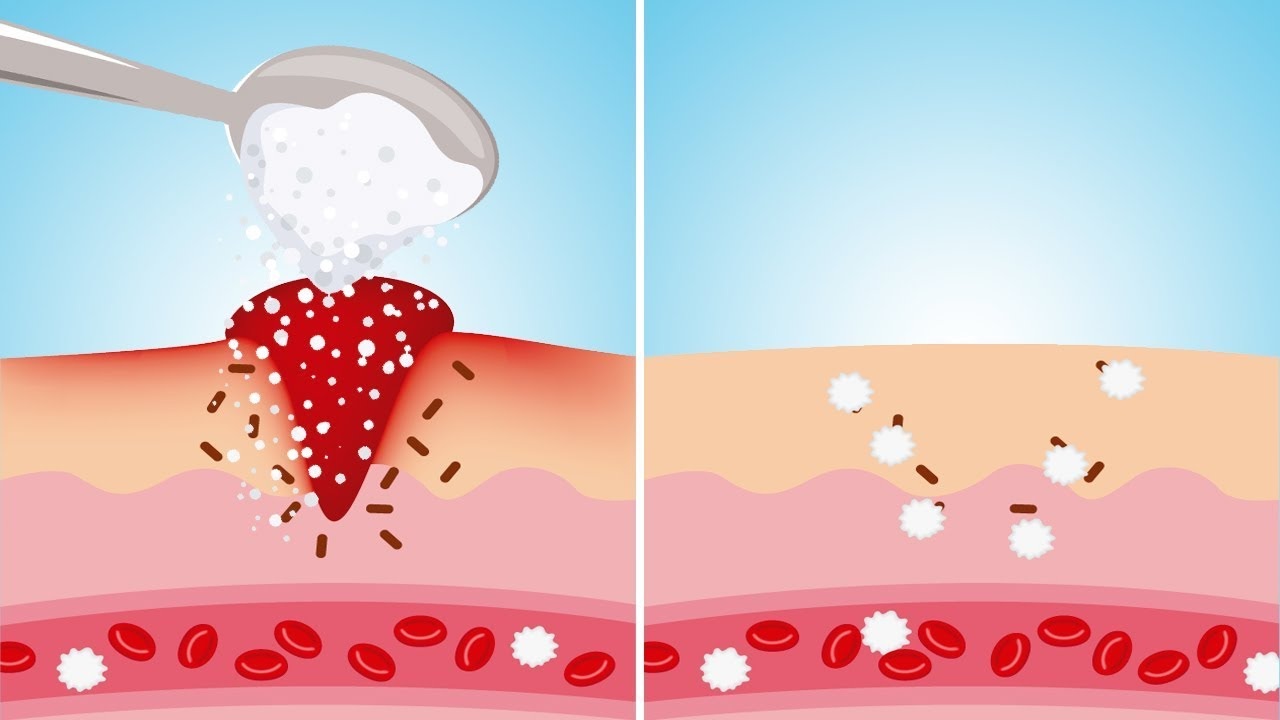 Treating Wounds With Sugar